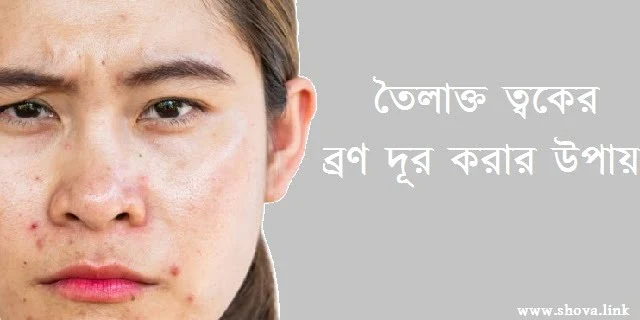তৈলাক্ত ত্বকের ব্রণ দূর করার উপায়